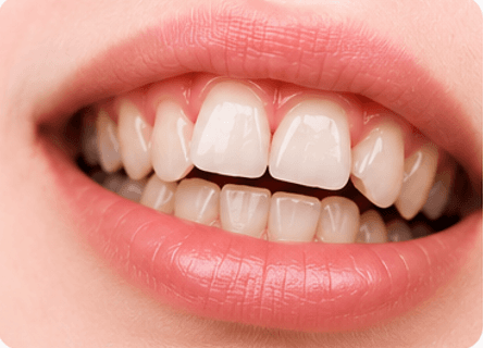 Misaligned Teeth