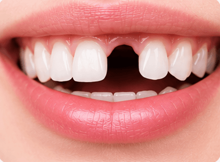 Missing Teeth