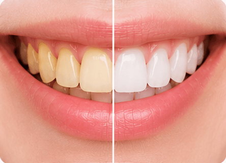 Tooth Stains & Discoloration