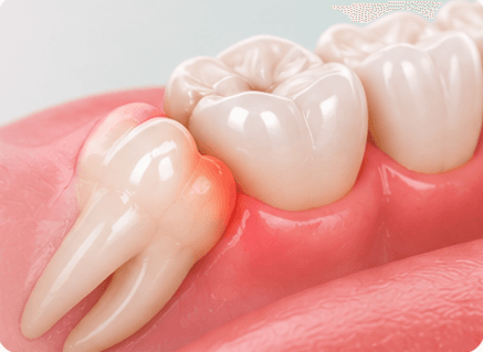 Wisdom Tooth Problems