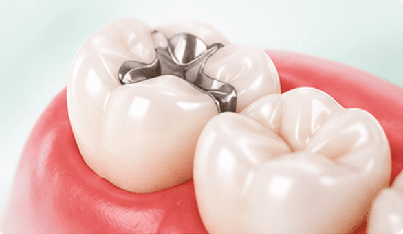 Dental Fillings