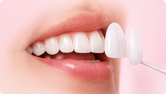 Dental Veneers
