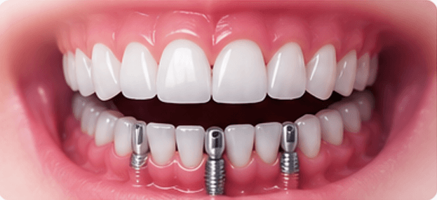 Full Mouth Rehabilitation