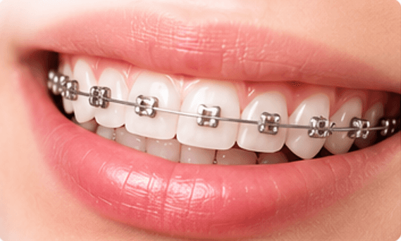 Teeth Alignment & Braces