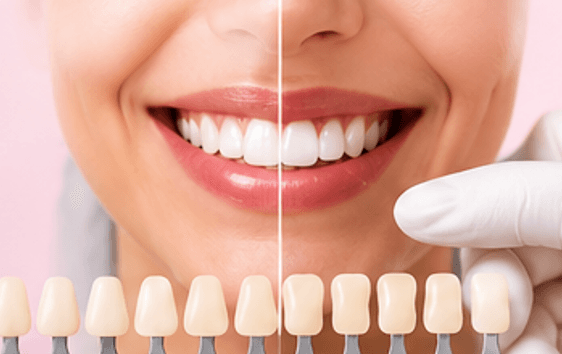 Teeth Whitening