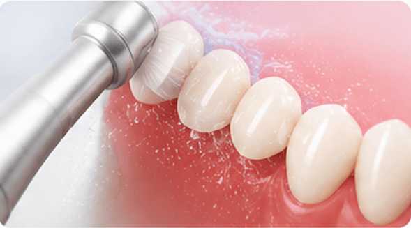 Teeth Cleaning & Polishing