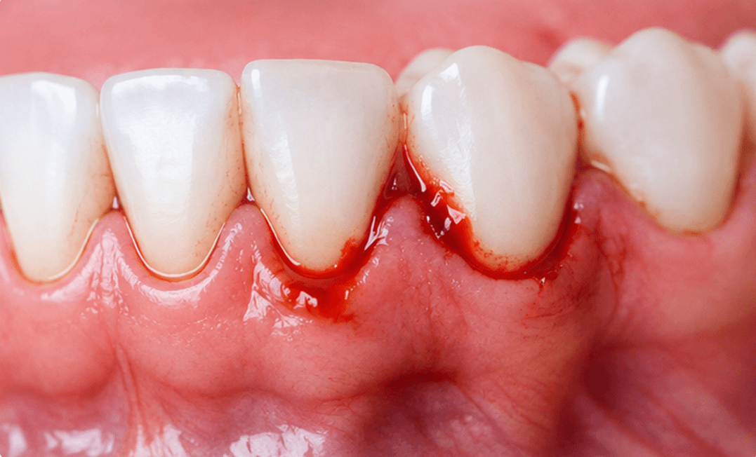 Bleeding Gums: Common Causes and When to See a Dentist