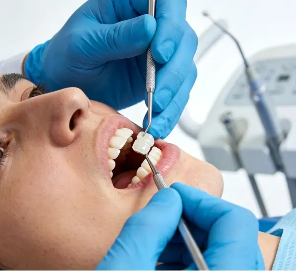 Dental Veneers
